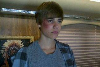 Justin Bieber fue golpeado Justin Bieber fue golpeado