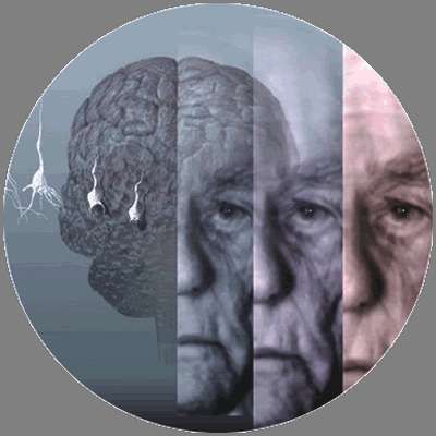Identifican nuevos genes de riesgo para la enfermedad de Alzheimer