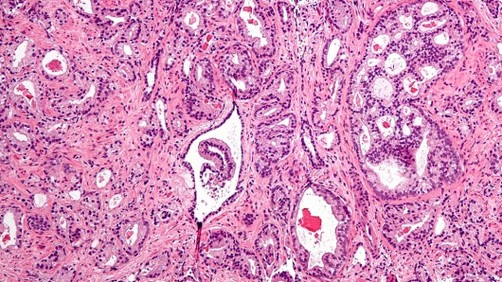 Un virus es la nueva esperanza contra el cáncer