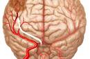 Estudio demuestra reducción del riesgo de desarrollar un Accidente Cerebro Vascular (ACV)