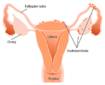 Sanidad retira un fármaco para la endometriosis