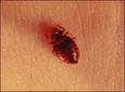 No deje que las chinches le chupen la sangre