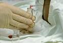 Presentan una terapia experimental para combatir el melanoma avanzado