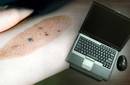 El calor de las laptops puede decolorar la piel y provocar dermatitis