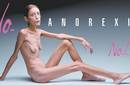 Isabelle Caro modelo anoréxica que posó para polémica campaña publicitaria ha muerto
