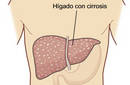 ¿Cómo se diagnostica la cirrosis?