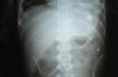 Niño brasileño de dos años vive con 50 agujas dentro de su cuerpo